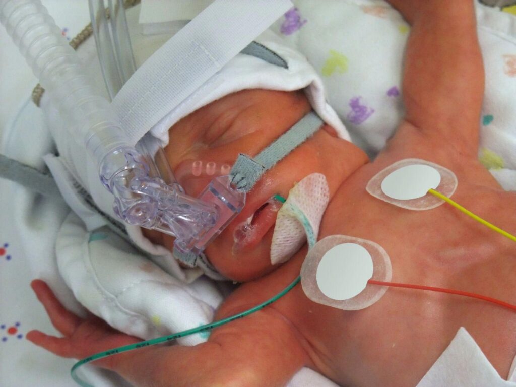 HIE in newborn in ICU